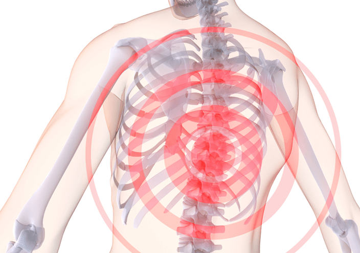 Osteocondrose da coluna torácica